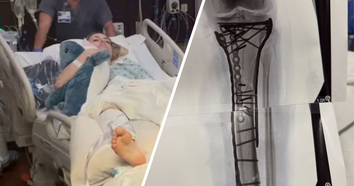 Vonns-Bein-nach-sechsst-ndiger-OP-voller-Platten-und-Schrauben-Fantastische-Arbeit-