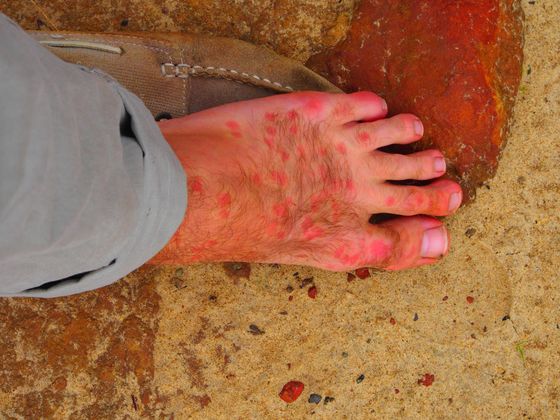 Schmerzhafte Erfahrung: Sein Fuß nach einem Bremsen-Angriff.