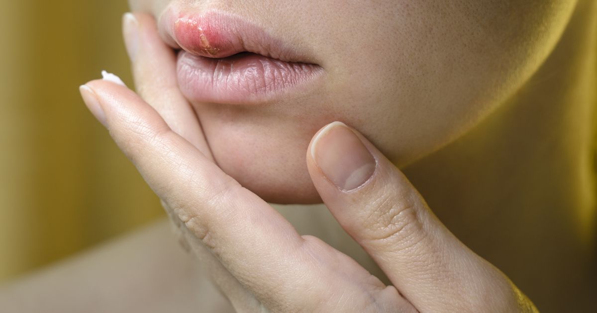Stiller-Mitbewohner-Herpes-Warum-die-Bl-schen-immer-wieder-kommen