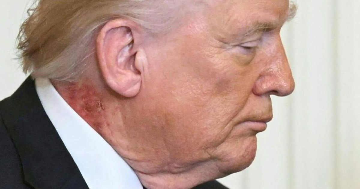 Seltsamer-roter-Fleck-an-Trumps-Hals-Neue-Spekulationen-ber-Gesundheitszustand