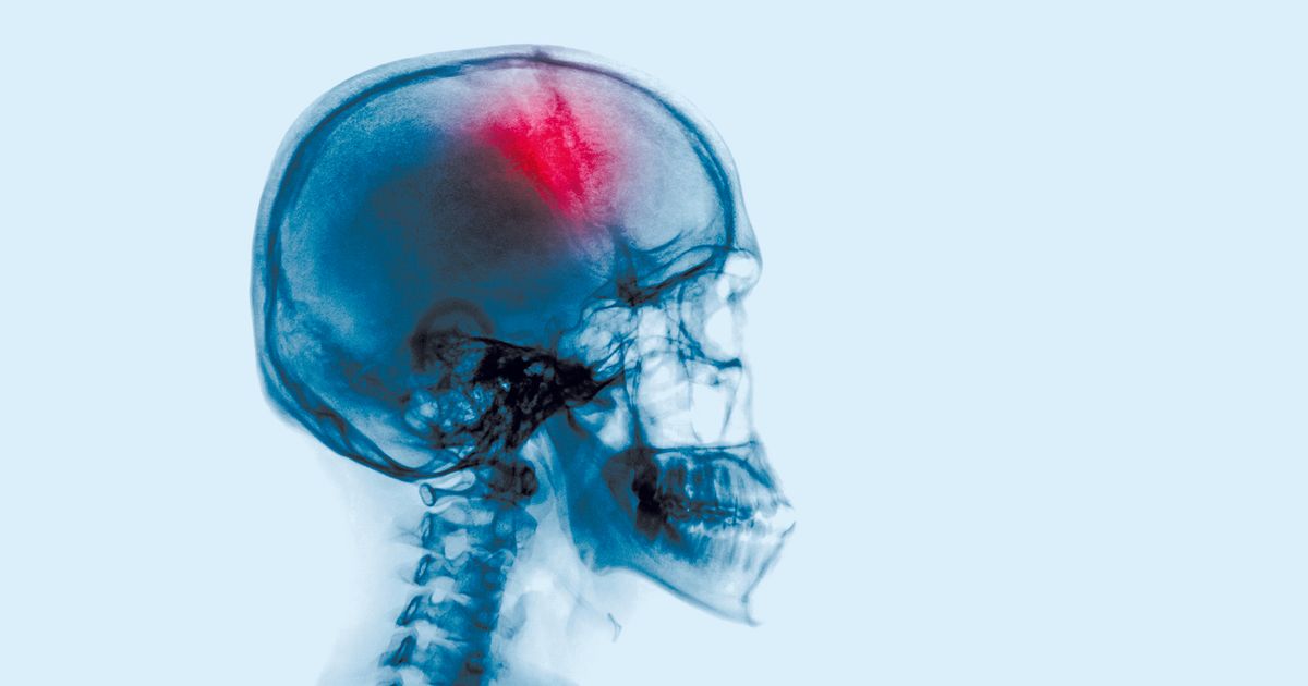 Schlaganfall: Bei Kathetereingriff krzere Beatmungsdauer besser | Tiroler  Tageszeitung  Aktuelle Nachrichten auf tt.com