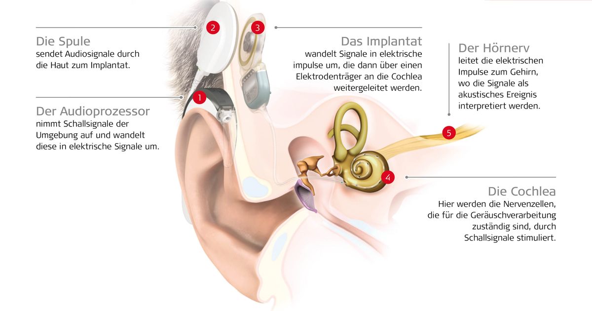 Kleine-Dinger-gro-e-Wirkung-So-lebt-Paula-geh-rlos-mit-H-rimplantaten